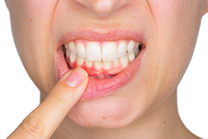 Gum Disease Treatment